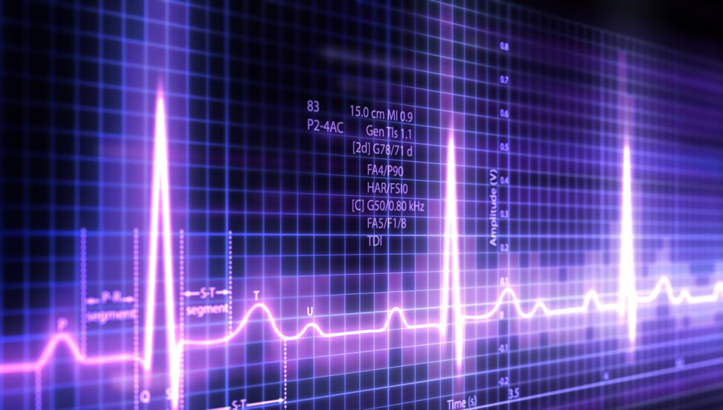 Purple zig-zaging lines on an EKG readout